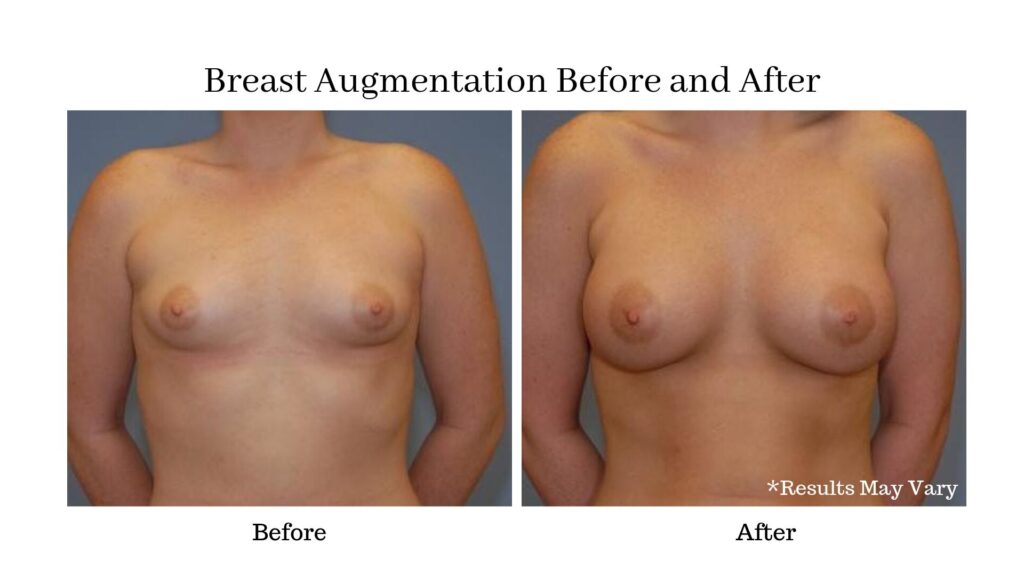 Breast Augmentation Before and After Patient of Dr. Mockler.