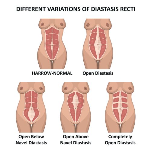 different variations of diastasis recti - Illustration