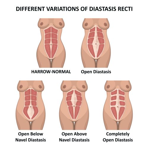 different variations of diastasis recti - Illustration