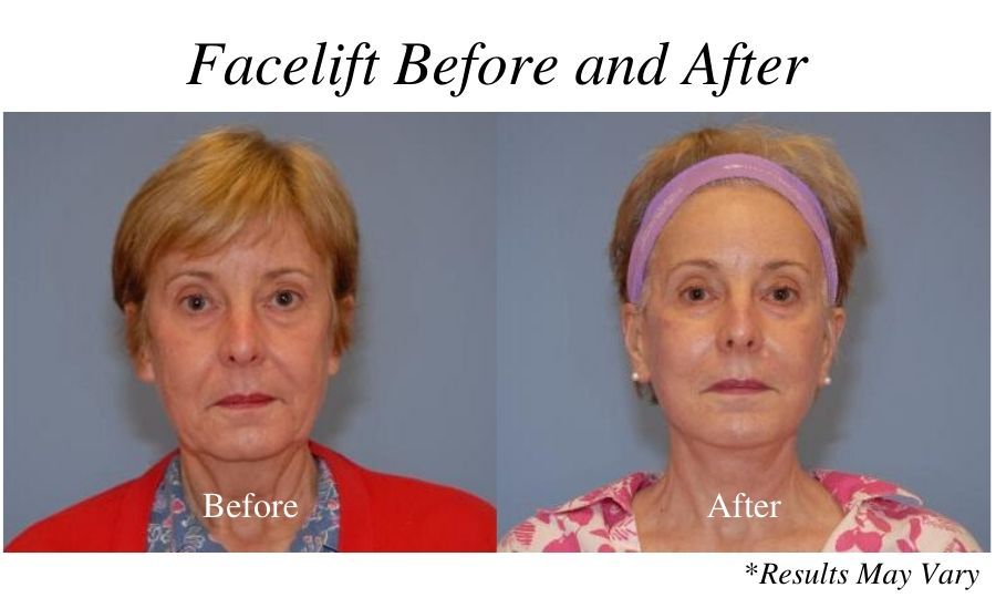 Before and after image showing the results of a facelift performed by Dr. Mockler in Panama City, Florida.