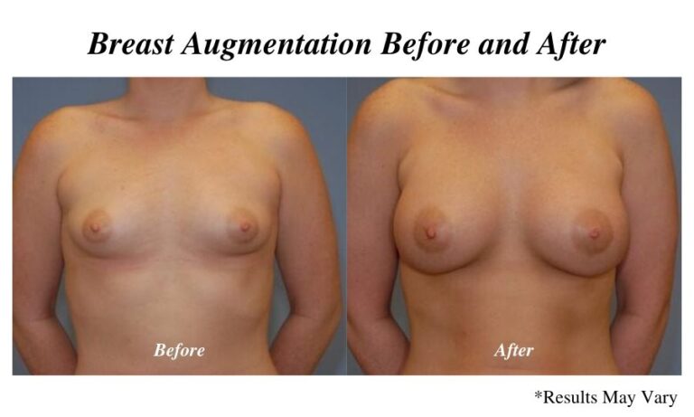 Before and after imaging showing the results of a breast augmentation performed in Panama City, FL.