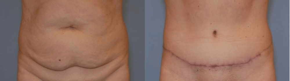 Before and after image showing the results of a tummy tuck performed in Panama City, FL.