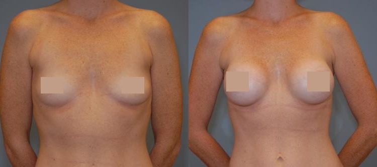 Dr. Raymond Mockler's female patient in her 30s had a Breast augmentation with saline implants