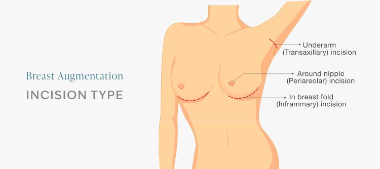 illustration: Breast augmentation Incision Type