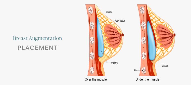 illustration: Breast augmentation Placement Option