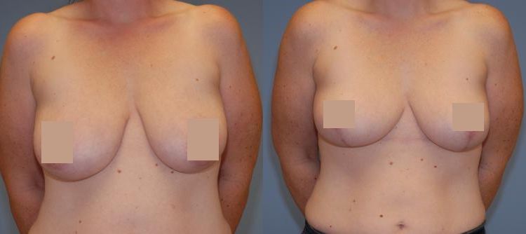 Before and after Breast Lift Surgery