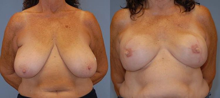 Before and after Tissue Expander Breast Reconstruction Surgery