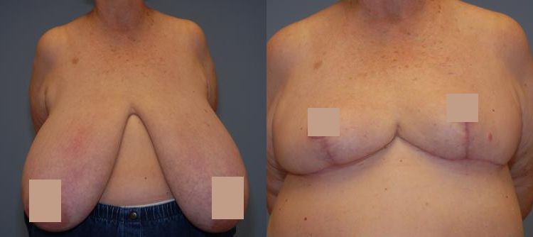Before and after results for breast reduction