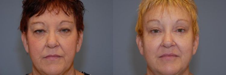 Before and after  blepharoplasty surgery