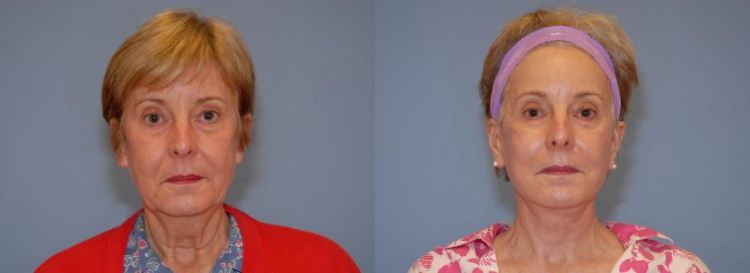 Before and After facelift surgery