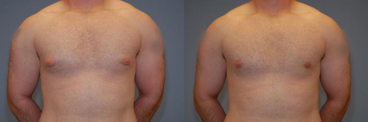 Before and after male breast reduction surgery