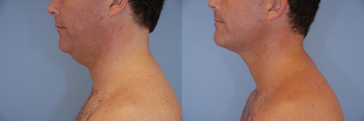 Before and After Liposuction of the neck