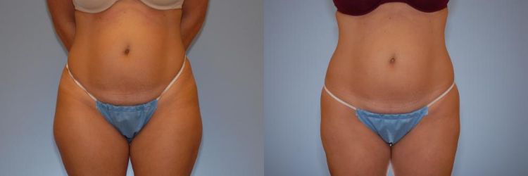 Before and After body contouring with Liposuction of the hips and thighs