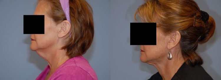 Before and after neck lift surgery