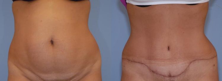 Before and After Tummy Tuck procedure