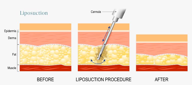 Illustrations: Liposuction procedure