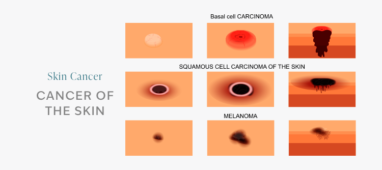 Illustrations: Types of Skin Cancer