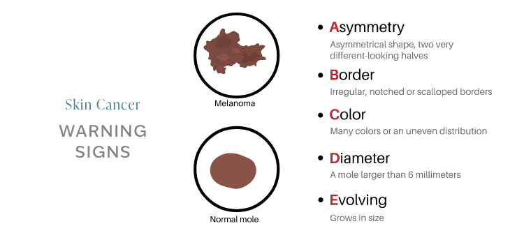 ABCDEs of skin cancer